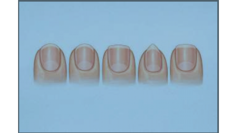 COMO CORTAR TUS UÑAS SEGÚN SU FORMA: LA CLAVE PARA PREVENIR PROBLEMAS EN LOS PIES